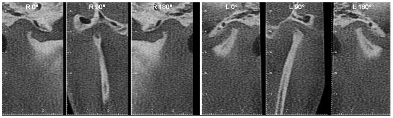 ATM E INFLAMAÇÃO. Processo degenerativo de ordem sistêmica